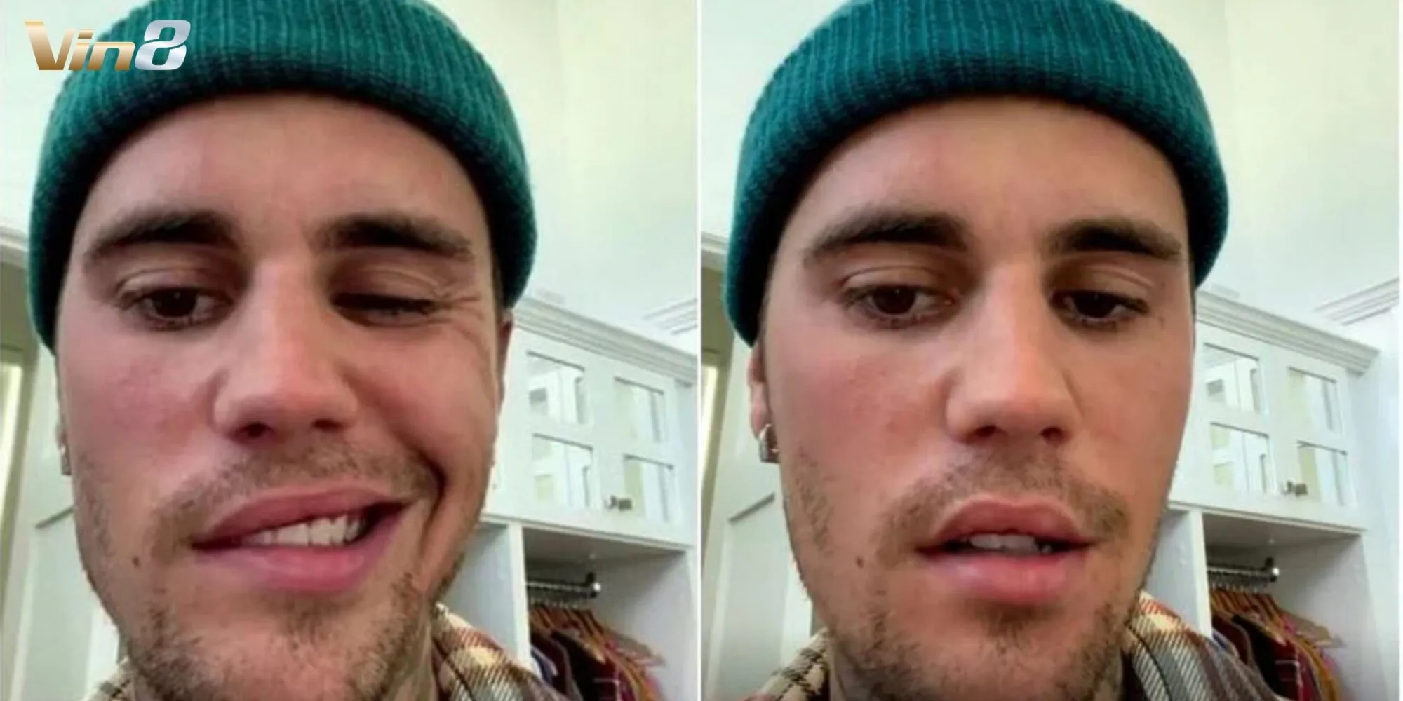 Justin Bieber chiến đấu với bệnh Lyme và hội chứng Ramsay Hunt Justin Bieber chiến đấu với bệnh Lyme và hội chứng Ramsay Hunt